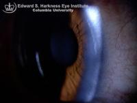 White Limbal Girdle of Vogt